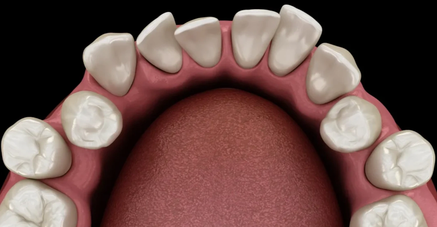 dents de travers In blog